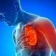 Jurisprudencia comentada. ¿Se considera accidente de trabajo el infarto de un trabajador pese a ser un gran fumador?